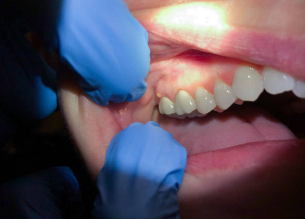 Best Emergency Treatment for Oral Infections in Caro, MI