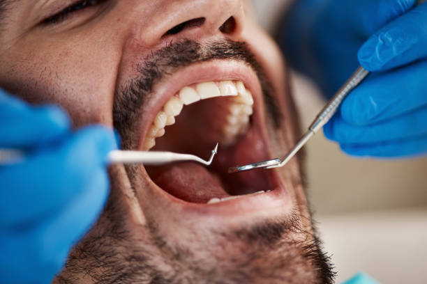 Best Emergency Treatment for Oral Infections in Caro, MI